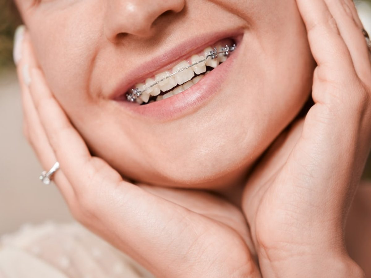 Braces for Adults, Kids, Teens